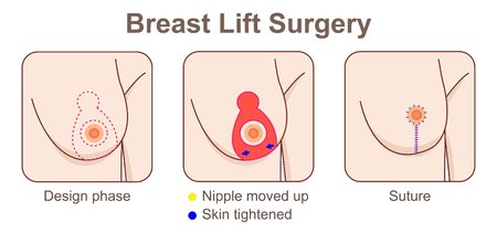 breast lift sketch1