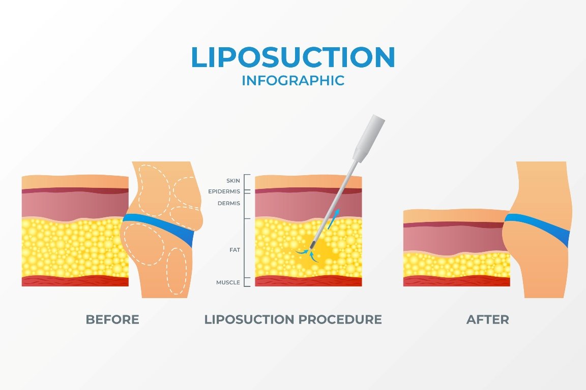 liposuction infographic site