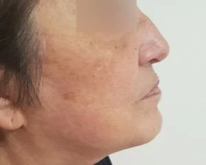 facelift_2__6-1845-300-240-80-c