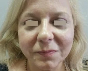 facelift_3__9-1847-300-240-80-c